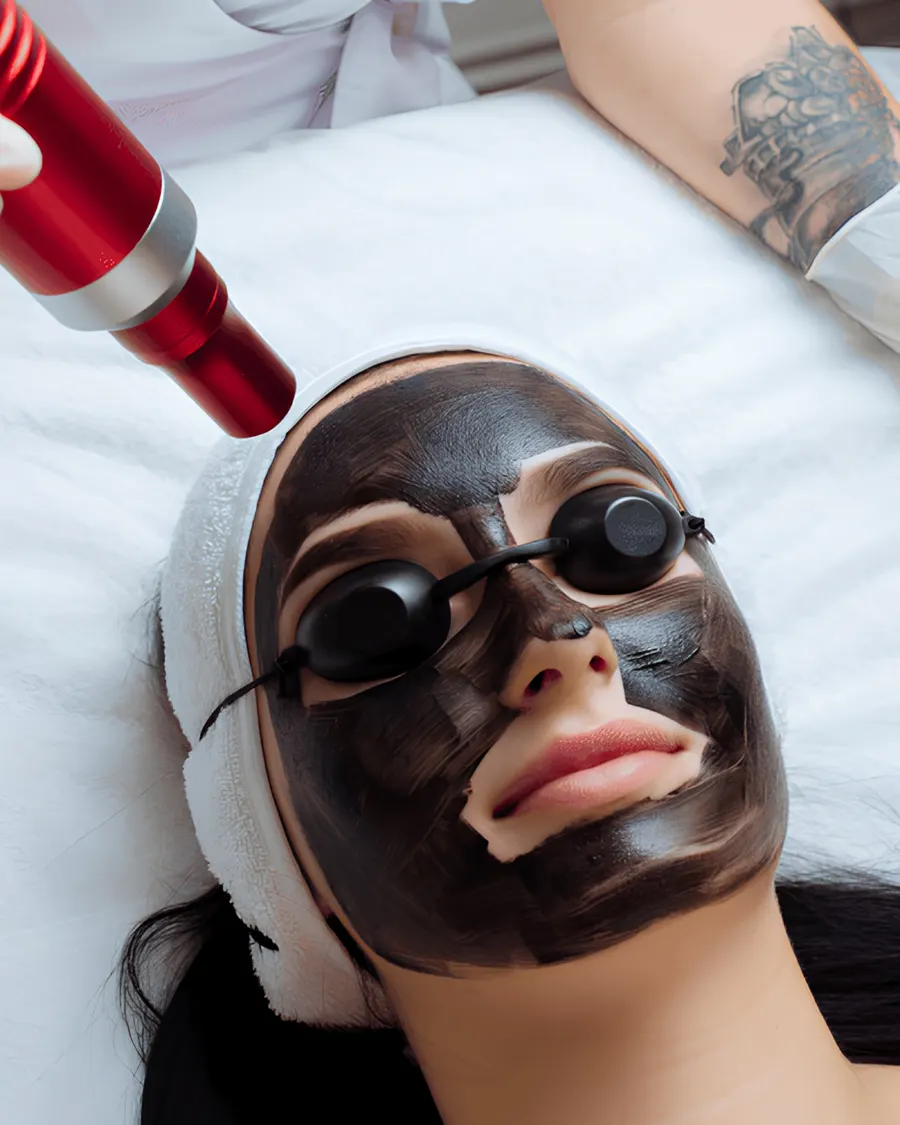 Advanced Skin Rejuvenation with Carbon Laser at Cinch Clinics